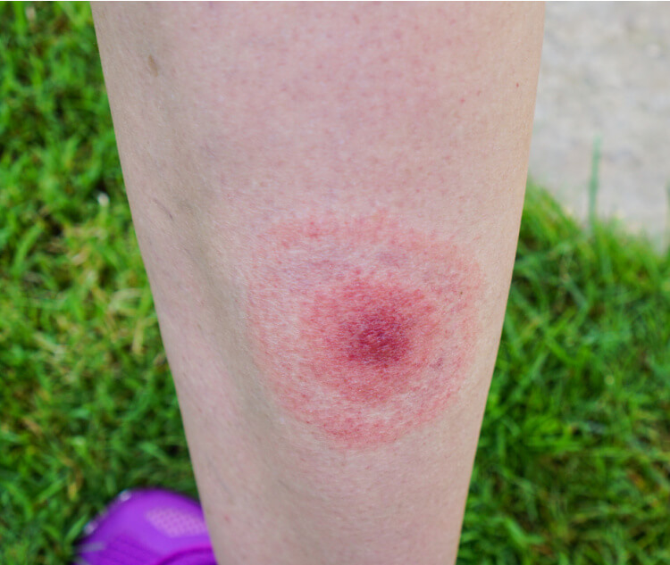 Initial symptoms are flu-like, with fevers, headache and stiff neck. You may also develop a bull’s eye type rash (pictured). This symptom is characteristic of Lyme disease but only around two-thirds of people get it.
Other symptoms include nerve pain or numbness, fatigue, cognitive issues and muscle and joint pain. Symptoms can take anywhere from 3 days to 3 months to appear.
